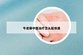 牛皮癣中医治疗怎么能快速