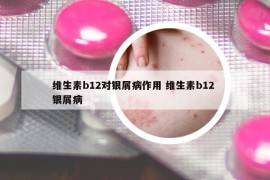 维生素b12对银屑病作用 维生素b12 银屑病