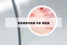 银屑病用丹参酮 丹参 银屑病