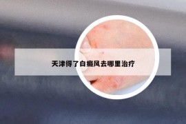 天津得了白癜风去哪里治疗