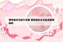 慢性咽炎引起牛皮癣 慢性咽炎会引起皮肤瘙痒吗