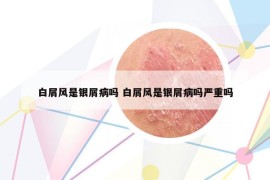 白屑风是银屑病吗 白屑风是银屑病吗严重吗