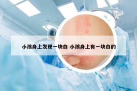 小孩身上发现一块白 小孩身上有一块白的