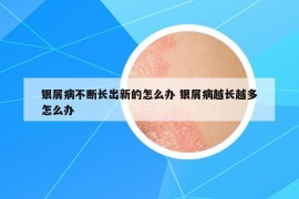 银屑病不断长出新的怎么办 银屑病越长越多怎么办