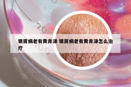 银屑病老有黄鼻涕 银屑病老有黄鼻涕怎么治疗