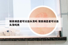 银屑病患者可以染头发吗 银屑病患者可以染头发吗男