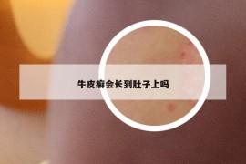 牛皮癣会长到肚子上吗