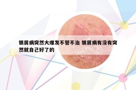 银屑病突然大爆发不管不治 银屑病有没有突然就自己好了的