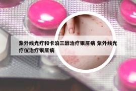 紫外线光疗和卡泊三醇治疗银屑病 紫外线光疗仪治疗银屑病