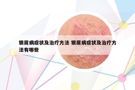 银屑病症状及治疗方法 银屑病症状及治疗方法有哪些