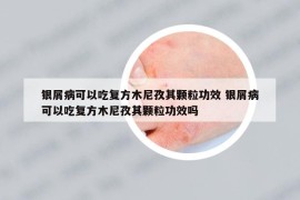 银屑病可以吃复方木尼孜其颗粒功效 银屑病可以吃复方木尼孜其颗粒功效吗