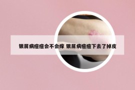 银屑病痘痘会不会痒 银屑病痘痘下去了掉皮