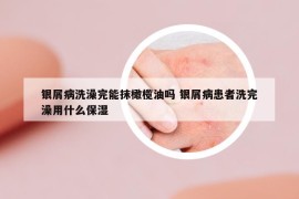 银屑病洗澡完能抹橄榄油吗 银屑病患者洗完澡用什么保湿