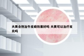 大黄合剂治牛皮癣效果好吗 大黄可以治疗皮炎吗