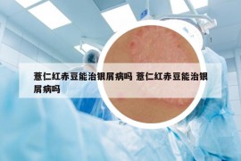 薏仁红赤豆能治银屑病吗 薏仁红赤豆能治银屑病吗