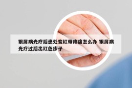 银屑病光疗后患处变红带疼痛怎么办 银屑病光疗过后出红色疹子