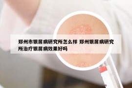 郑州市银屑病研究所怎么样 郑州银屑病研究所治疗银屑病效果好吗