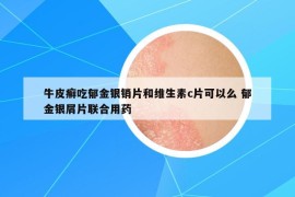 牛皮癣吃郁金银销片和维生素c片可以么 郁金银屑片联合用药