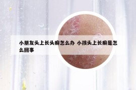 小朋友头上长头癣怎么办 小孩头上长癣是怎么回事