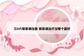 三0六银屑病仪器 银屑病治疗仪哪个最好