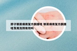 脖子银屑病用复方酮康唑 银屑病用复方酮康唑发用洗剂有效吗