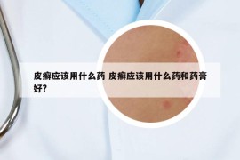 皮癣应该用什么药 皮癣应该用什么药和药膏好?