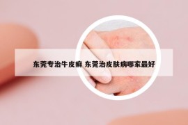 东莞专治牛皮癣 东莞治皮肤病哪家最好