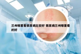 兰州哪里看银屑病比较好 银屑病兰州哪里看的好