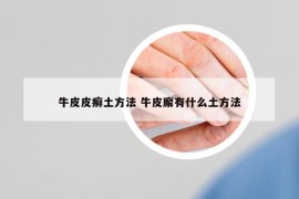 牛皮皮癣土方法 牛皮廨有什么土方法