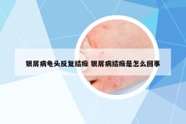 银屑病龟头反复结痂 银屑病结痂是怎么回事