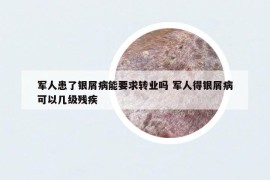 军人患了银屑病能要求转业吗 军人得银屑病可以几级残疾