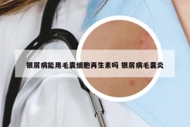 银屑病能用毛囊细胞再生素吗 银屑病毛囊炎