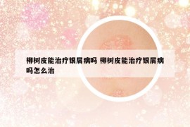 柳树皮能治疗银屑病吗 柳树皮能治疗银屑病吗怎么治