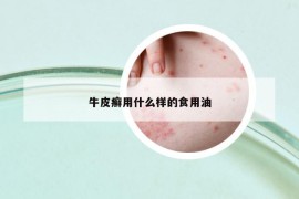 牛皮癣用什么样的食用油