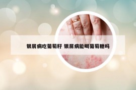 银屑病吃葡萄籽 银屑病能喝葡萄糖吗