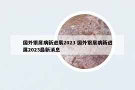 国外银屑病新进展2023 国外银屑病新进展2023最新消息