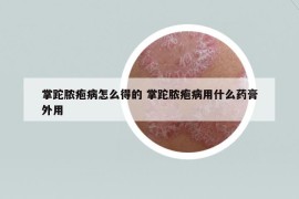 掌跎脓疱病怎么得的 掌跎脓疱病用什么药膏外用