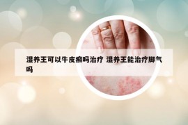 湿养王可以牛皮癣吗治疗 湿养王能治疗脚气吗