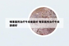 哪里医院治疗牛皮廨最好 哪家医院治疗牛皮肤癣好