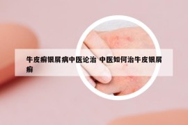 牛皮癣银屑病中医论治 中医如何治牛皮银屑癣