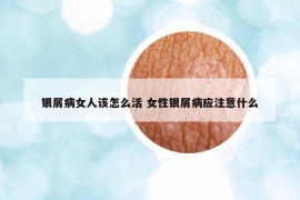 银屑病女人该怎么活 女性银屑病应注意什么