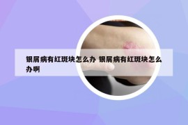 银屑病有红斑块怎么办 银屑病有红斑块怎么办啊