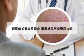 银屑病关节炎片能吃 银屑病关节炎要忌口吗