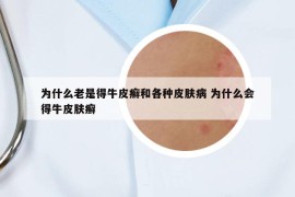 为什么老是得牛皮癣和各种皮肤病 为什么会得牛皮肤癣