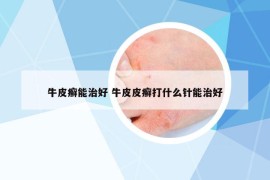 牛皮癣能治好 牛皮皮癣打什么针能治好