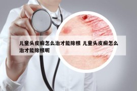 儿童头皮癣怎么治才能除根 儿童头皮癣怎么治才能除根呢