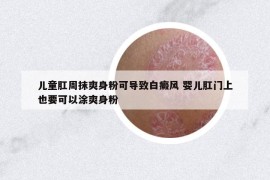 儿童肛周抹爽身粉可导致白癜风 婴儿肛门上也要可以涂爽身粉