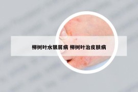 柳树叶水银屑病 柳树叶治皮肤病