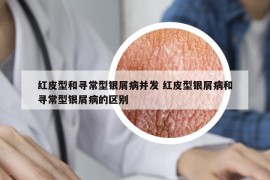 红皮型和寻常型银屑病并发 红皮型银屑病和寻常型银屑病的区别