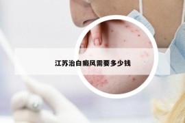 江苏治白癜风需要多少钱